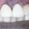 Crowns Before